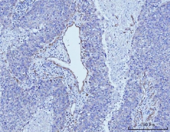 IHC staining of FFPE human liver cancer tissue with CD93 antibody. HIER: boil tissue sections in pH8 EDTA for 20 min and allow to cool before testing.