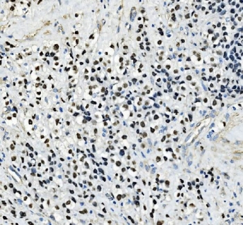 IHC staining of FFPE human testicular cancer tissue with AP2 gamma antibody. HIER: boil tissue sections in pH8 EDTA for 20 min and allow to cool before testing.