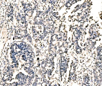 IHC staining of FFPE human bladder epithelial carcinoma tissue with KIAA1429 antibody. HIER: boil tissue sections in pH8 EDTA for 20 min and allow to cool before testing.