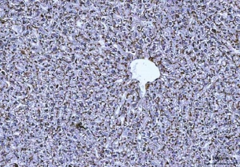 IHC staining of FFPE mouse liver cancer tissue with CTSB antibody. HIER: boil tissue sections in pH8 EDTA for 20 min and allow to cool before testing.