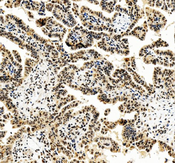 IHC staining of FFPE human lung cancer tissue with FOXL2 antibody, HRP-secondary and DAB substrate. HIER: boil tissue sections in pH8 EDTA for 20 min and allow to cool before testing.