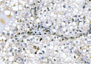 IHC staining of FFPE human renal cell carcinoma tissue with GADD45B antibody. HIER: boil tissue sections in pH8 EDTA for 20 min and allow to cool before testing.
