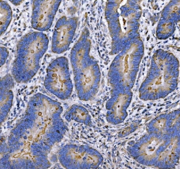 IHC staining of FFPE moderately differentiated adenocarcinoma of the human rectum with MUC-1 antibody. HIER: boil tissue sections in pH8 EDTA for 20 min and allow to cool before testing.