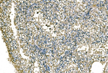 NEDD4 Antibody Renal Cell Carcinoma IHC Tumor Tissue. Immunohistochemistry analysis of Neural precursor cell expressed developmentally down-regulated protein 4 / NEDD4 in FFPE human renal cell carcinoma tissue using NEDD4 Antibody for IHC. HRP-DAB brown chromogenic staining demonstrates cytoplasmic and membrane-associated localization in tumor epithelial cells, with variable intensity across the tumor field, while surrounding stromal regions show comparatively reduced signal. The staining pattern highlights tumor cell architecture and supports evaluation of NEDD4 expression within the tumor microenvironment. HIER: boil tissue sections in pH8 EDTA for 20 min and allow to cool before testing.