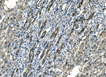 NEDD4 Antibody Liver Cancer IHC Tumor Tissue. Immunohistochemistry analysis of Neural precursor cell expressed developmentally down-regulated protein 4 / NEDD4 in FFPE human liver cancer tissue using NEDD4 Antibody for IHC. HRP-DAB brown chromogenic staining demonstrates cytoplasmic and membrane-associated localization in tumor epithelial cells, with heterogeneous staining intensity across tumor regions and reduced signal in surrounding stromal compartments. The staining pattern highlights tumor cell morphology and supports evaluation of NEDD4 expression within hepatic tumor tissue. HIER: boil tissue sections in pH8 EDTA for 20 min and allow to cool before testing.
