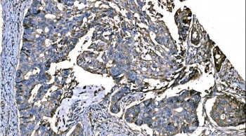 NEDD4 Antibody Colon Adenocarcinoma IHC Tumor Architecture. Immunohistochemistry analysis of Neural precursor cell expressed developmentally down-regulated protein 4 / NEDD4 in FFPE human colon adenocarcinoma tissue using NEDD4 Antibody for IHC. HRP-DAB brown chromogenic staining demonstrates cytoplasmic and membrane-associated localization in gland-forming tumor epithelial cells, with variable staining intensity across malignant glands and reduced signal in stromal regions. The staining pattern highlights glandular tumor architecture and supports evaluation of NEDD4 expression in colorectal carcinoma tissue. HIER: boil tissue sections in pH8 EDTA for 20 min and allow to cool before testing.