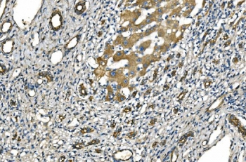 IHC staining of FFPE human liver cancer tissue with NLRP7 antibody. HIER: boil tissue sections in pH8 EDTA for 20 min and allow to cool before testing.