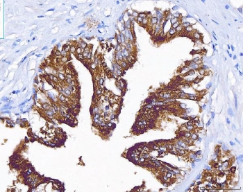 ACP3 Antibody immunohistochemistry analysis of Prostatic acid phosphatase in human prostate cancer tissue. FFPE human prostate carcinoma tissue was stained with ACP3 antibody following heat induced epitope retrieval by boiling sections in pH8 EDTA buffer for 20 minutes prior to cooling and staining. HRP-DAB brown chromogenic signal highlights strong cytoplasmic staining in prostate tumor epithelial cells lining glandular carcinoma structures, consistent with the known expression pattern of Prostatic acid phosphatase (PAP/ACP3) in prostate epithelial differentiation and prostate cancer. Prostatic acid phosphatase immunohistochemistry is widely used in prostate cancer research to identify prostate-derived tumor cells and evaluate PAP expression in prostate carcinoma.