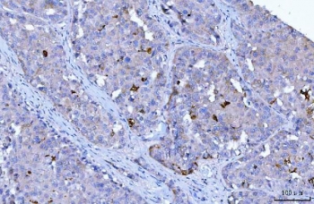 IHC staining of FFPE human hepatocellular carcinoma tissue with HRS antibody. HIER: boil tissue sections in pH8 EDTA for 20 min and allow to cool before testing.