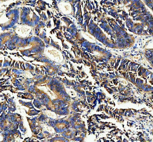 TEM8 Antibody Human Colon Cancer IHC. Immunohistochemical analysis of TEM8 Antibody / Tumor Endothelial Marker Antibody in FFPE human colon cancer tissue following heat-induced antigen retrieval in pH 8 EDTA buffer. The section was incubated with TEM8 antibody at 2 ug/ml and detected using an HRP-conjugated secondary antibody with DAB chromogen. Positive staining is observed in colon cancer cells, consistent with ANTXR1 expression. This TEM8 Antibody, a tumor endothelial marker antibody, is suitable for investigating receptor expression, tumor angiogenesis and cancer-associated endothelial biology.