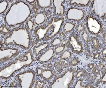 IHC staining of FFPE human thyroiditis tissue with SCA2 antibody. HIER: boil tissue sections in pH8 EDTA for 20 min and allow to cool before testing.