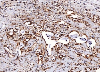 IHC staining of FFPE human gastric carcinoma tissue with ENO1 antibody. HIER: boil tissue sections in pH8 EDTA for 20 min and allow to cool before testing.