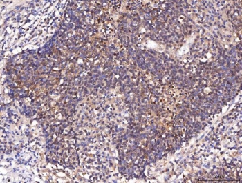 IHC staining of FFPE human lung cancer tissue with ENO1 antibody. HIER: boil tissue sections in pH8 EDTA for 20 min and allow to cool before testing.