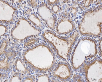 IHC staining of FFPE human poison impregnated thyroid gland tissue with FIS1 antibody. HIER: boil tissue sections in pH8 EDTA for 20 min and allow to cool before testing.
