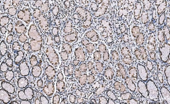 IHC staining of FFPE human gastric carcinoma tissue with H1F0 antibody. HIER: boil tissue sections in pH8 EDTA for 20 min and allow to cool before testing.