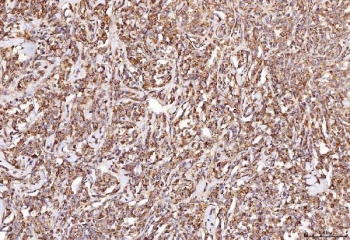 IHC staining of FFPE human lymphoma tissue with RAB5A/B/C antibody. HIER: boil tissue sections in pH8 EDTA for 20 min and allow to cool before testing.