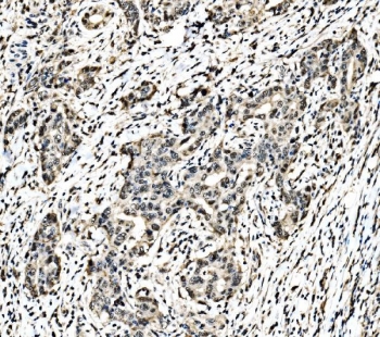 c-Jun Antibody Renal Pelvis Squamous Metaplasia IHC. Immunohistochemical staining of FFPE human renal pelvis squamous metaplasia tissue using c-Jun Antibody demonstrates predominantly nuclear HRP-DAB brown staining within metaplastic epithelial cell populations. The staining pattern is consistent with expression of c-Jun (JUN), a DNA-binding transcription factor that functions as a key regulator of gene expression downstream of AP-1 signaling pathways. As a transcriptional regulation protein, c-Jun participates in cellular differentiation, stress responses, tissue remodeling, and signal transduction processes. Nuclear localization of c-Jun supports its role in controlling transcriptional programs associated with epithelial adaptation and phenotypic change. HIER: boil tissue sections in pH 8 EDTA buffer for 20 minutes and allow to cool before testing.