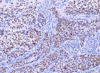MSH2 Antibody Mouse Monoclonal 6B4F7. Immunohistochemistry of FFPE human laryngeal squamous cell carcinoma tissue demonstrates strong nuclear staining in tumor epithelial cells, consistent with the nuclear localization of MutS homolog 2 (MSH2), a key DNA mismatch repair protein. Brown chromogenic signal highlights MSH2-positive nuclei across the carcinoma cell population, while surrounding stromal cells show weaker or variable staining. Heat-induced epitope retrieval was performed by boiling tissue sections in pH8 EDTA buffer for 20 minutes followed by cooling prior to antibody incubation.