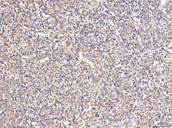 IHC staining of FFPE human glioma tissue with COX2 antibody. HIER: boil tissue sections in pH8 EDTA for 20 min and allow to cool before testing.