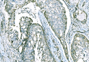 IHC staining of FFPE human adenocarcinoma of the right colon tissue with CD101 antibody. HIER: boil tissue sections in pH8 EDTA for 20 min and allow to cool before testing.