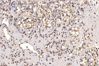 IHC staining of FFPE human renal clear cell carcinoma tissue with PTP1C antibody. HIER: boil tissue sections in pH8 EDTA for 20 min and allow to cool before testing.