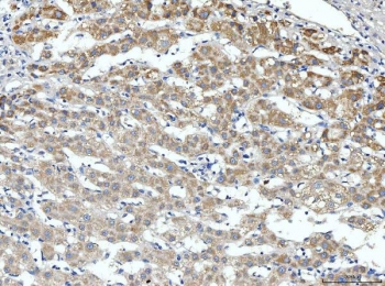 IHC staining of FFPE human liver cancer tissue with Aldehyde dehydrogenase 3 antibody. HIER: boil tissue sections in pH8 EDTA for 20 min and allow to cool before testing.