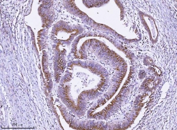 IHC staining of FFPE human rectal cancer tissue with ALDH3 antibody. HIER: boil tissue sections in pH8 EDTA for 20 min and allow to cool before testing.