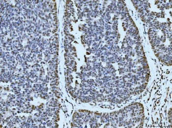 IHC staining of FFPE human bladder epithelial carcinoma tissue with p53 binding protein 1 antibody. HIER: boil tissue sections in pH8 EDTA for 20 min and allow to cool before testing.