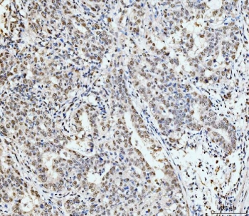 IHC staining of FFPE human metaplasia of squamous cells of the renal pelvis tissue with p53 binding protein 1 antibody. HIER: boil tissue sections in pH8 EDTA for 20 min and allow to cool before testing.