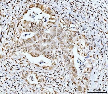 IHC staining of FFPE human moderately differentiated rectal adenocarcinoma tissue with p53 binding protein 1 antibody. HIER: boil tissue sections in pH8 EDTA for 20 min and allow to cool before testing.