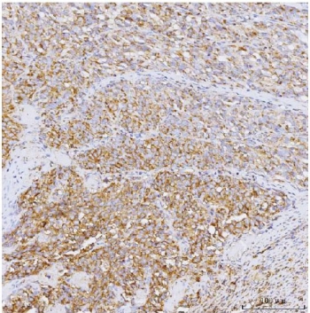 PPP1R15A Antibody Human Melanoma IHC. Immunohistochemical staining of FFPE human melanoma tissue using PPP1R15A antibody following heat-induced epitope retrieval in pH8 EDTA buffer. Detection was performed using an HRP-based staining system. Tumor cells exhibit widespread cytoplasmic immunoreactivity with variable staining intensity throughout the melanoma tissue, consistent with expression of Protein Phosphatase 1 Regulatory Subunit 15A (GADD34), a regulator of the integrated stress response and eIF2alpha signaling. This result demonstrates that the PPP1R15A Antibody / Protein Phosphatase 1 Regulatory Subunit 15A Antibody is suitable for immunohistochemical detection of endogenous PPP1R15A in formalin-fixed, paraffin-embedded human tissues.