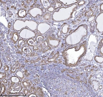DBN1 Antibody Thyroid Cancer IHC. Immunohistochemistry analysis of FFPE human thyroid carcinoma tissue using DBN1 antibody shows cytoplasmic and membranous staining in tumor epithelial cells outlining glandular structures, consistent with DBN1 / Drebrin localization associated with actin cytoskeletal organization. Surrounding stromal regions display comparatively lower signal, and hematoxylin counterstain provides nuclear contrast and tissue architecture. HIER: boil FFPE tissue sections in pH 8 EDTA for 20 min and allow to cool before testing.