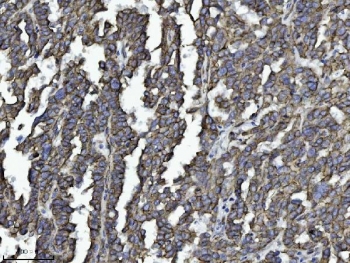 DBN1 Antibody Ovarian Serous Carcinoma IHC. Immunohistochemistry analysis of FFPE human ovarian serous carcinoma tissue using DBN1 antibody shows cytoplasmic and membranous staining in tumor epithelial cells forming papillary and glandular structures, consistent with DBN1 / Drebrin localization associated with actin cytoskeletal organization. Adjacent stromal areas display lower staining intensity, and hematoxylin counterstain provides nuclear contrast and structural context. HIER: boil FFPE tissue sections in pH 8 EDTA for 20 min and allow to cool before testing.