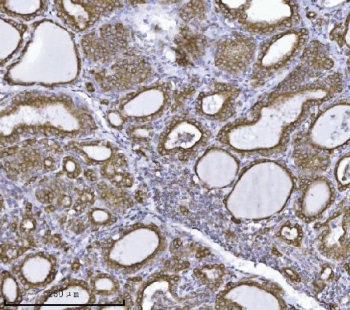 IHC staining of FFPE human thyroiditis tissue with ERLIN2 antibody. HIER: boil tissue sections in pH8 EDTA for 20 min and allow to cool before testing.