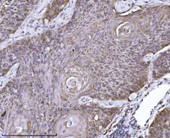 IHC staining of FFPE human squamous cell lung carcinoma tissue with ERLIN2 antibody. HIER: boil tissue sections in pH8 EDTA for 20 min and allow to cool before testing.