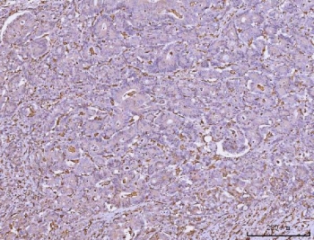 IHC staining of FFPE human colonic adenocarcinoma tissue with HLA-DRA antibody. HIER: boil tissue sections in pH8 EDTA for 20 min and allow to cool before testing.