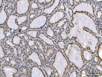 IHC staining of FFPE human thyroiditis tissue with Ataxin 1 antibody. HIER: boil tissue sections in pH8 EDTA for 20 min and allow to cool before testing.