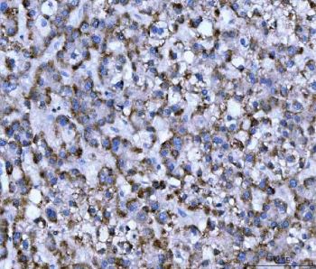 IHC staining of FFPE human liver cancer tissue with WD repeat-containing protein 1 antibody. HIER: boil tissue sections in pH8 EDTA for 20 min and allow to cool before testing.