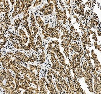 IHC staining of FFPE human liver cancer tissue with ALYREF antibody, HRP-secondary and DAB substrate. HIER: boil tissue sections in pH8 EDTA for 20 min and allow to cool before testing.