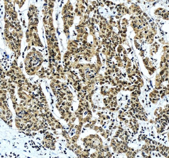 IHC staining of FFPE human liver cancer tissue with ALYREF antibody, HRP-secondary and DAB substrate. HIER: boil tissue sections in pH8 EDTA for 20 min and allow to cool before testing.