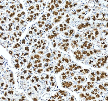 IHC staining of FFPE human stomach cancer tissue with ATP4A antibody, HRP-secondary and DAB substrate. HIER: boil tissue sections in pH8 EDTA for 20 min and allow to cool before testing.