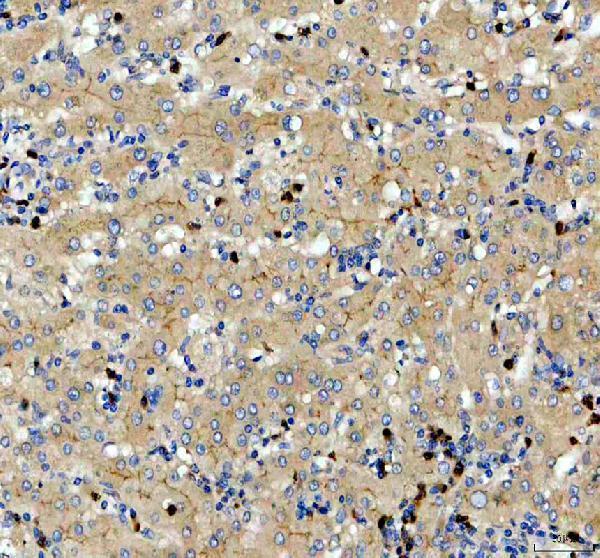 Tetherin Antibody / BST2 Antiviral Protein Antibody Human Liver Cancer IHC. Immunohistochemical staining of FFPE human liver cancer tissue using Tetherin Antibody / BST2 Antiviral Protein Antibody. Tetherin expression is detected predominantly within the cytoplasm and cell membrane of tumor cells, consistent with its role as an interferon-inducible antiviral restriction factor and cell surface glycoprotein. Heat-induced epitope retrieval was performed in pH 8.0 EDTA buffer prior to staining. Tissue sections were blocked with 10% goat serum and incubated with the primary antibody (2 ug/ml) overnight at 4Â°C, followed by a peroxidase-conjugated goat anti-rabbit IgG secondary antibody. Immunoreactivity was visualized using an HRP Super Vision detection system with DAB as the chromogen.