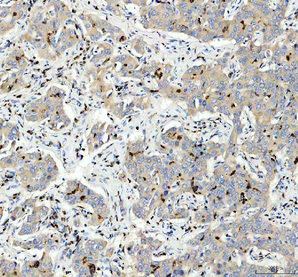 Tetherin Antibody / BST2 Antiviral Protein Antibody Hepatocellular Carcinoma IHC. Immunohistochemical staining of FFPE human liver cancer tissue using Tetherin Antibody / BST2 Antiviral Protein Antibody. Tetherin is detected predominantly within the cytoplasm and cell membrane of tumor cells, consistent with its role as an interferon-inducible antiviral restriction factor and cell surface glycoprotein. Heat-induced epitope retrieval was performed in pH 8.0 EDTA buffer prior to staining. Tissue sections were blocked with 10% goat serum and incubated with the primary antibody (2 ug/ml) overnight at 4Â°C, followed by a peroxidase-conjugated goat anti-rabbit IgG secondary antibody. Immunoreactivity was visualized using an HRP Super Vision detection system with DAB as the chromogen.