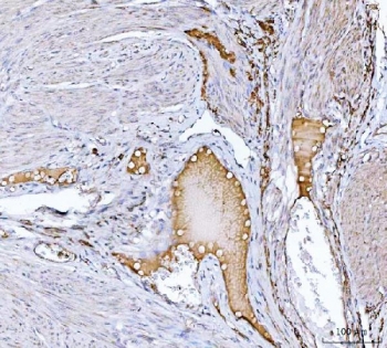 Clusterin Antibody Endometrial Cancer IHC. Immunohistochemistry staining of FFPE human endometrial cancer tissue with Clusterin antibody. HIER: boil tissue sections in pH8 EDTA for 20 min and allow to cool before testing.