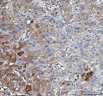IHC staining of FFPE human liver cancer tissue with Insulin receptor substrate 2 antibody. HIER: boil tissue sections in pH8 EDTA for 20 min and allow to cool before testing.