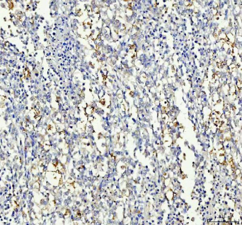 IHC staining of FFPE human lung cancer tissue with Insulin receptor substrate 2 antibody. HIER: boil tissue sections in pH8 EDTA for 20 min and allow to cool before testing.