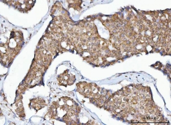 IHC staining of FFPE human breast cancer tissue with Mitochondrial fission factor antibody. HIER: boil tissue sections in pH8 EDTA for 20 min and allow to cool before testing.