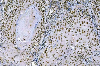 Ki-67 Rabbit Polyclonal IHC Antibody / MKI67 Immunohistochemistry Antibody. Immunohistochemistry analysis of FFPE human laryngeal squamous cell carcinoma tissue using Ki-67 rabbit polyclonal IHC antibody. Strong nuclear brown staining is observed in numerous tumor epithelial cells, consistent with the known expression pattern of Ki-67 / MKI67 in actively proliferating cells. The staining highlights proliferating carcinoma cells within the tumor while surrounding stromal elements show comparatively lower labeling. Heat-induced epitope retrieval was performed by boiling tissue sections in pH8 EDTA buffer for 20 minutes followed by cooling prior to staining.