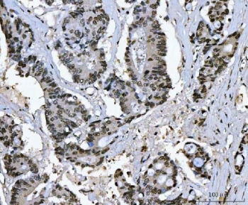 Ki-67 Rabbit Polyclonal IHC Antibody / MKI67 Immunohistochemistry Antibody. Immunohistochemistry analysis of FFPE human colonic adenocarcinoma tissue using Ki-67 rabbit polyclonal IHC antibody. Prominent nuclear brown staining is observed in many tumor epithelial cells lining the malignant glandular structures, consistent with the known expression pattern of Ki-67 / MKI67 in actively proliferating cells. The staining highlights proliferating carcinoma cells within the tumor glands while surrounding stromal tissue shows comparatively lower labeling. Heat-induced epitope retrieval was performed by boiling tissue sections in pH8 EDTA buffer for 20 minutes followed by cooling prior to staining.