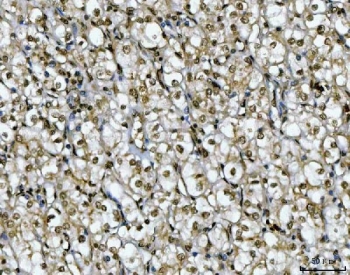 IHC staining of FFPE human renal carcinoma tissue with Ki-67 antibody. HIER: boil tissue sections in pH8 EDTA for 20 min and allow to cool before testing.
